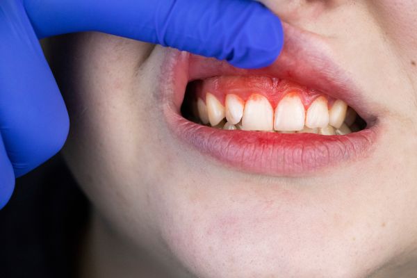 Trị viêm nướu răng tại nhà bằng lá lốt có hiệu quả không?